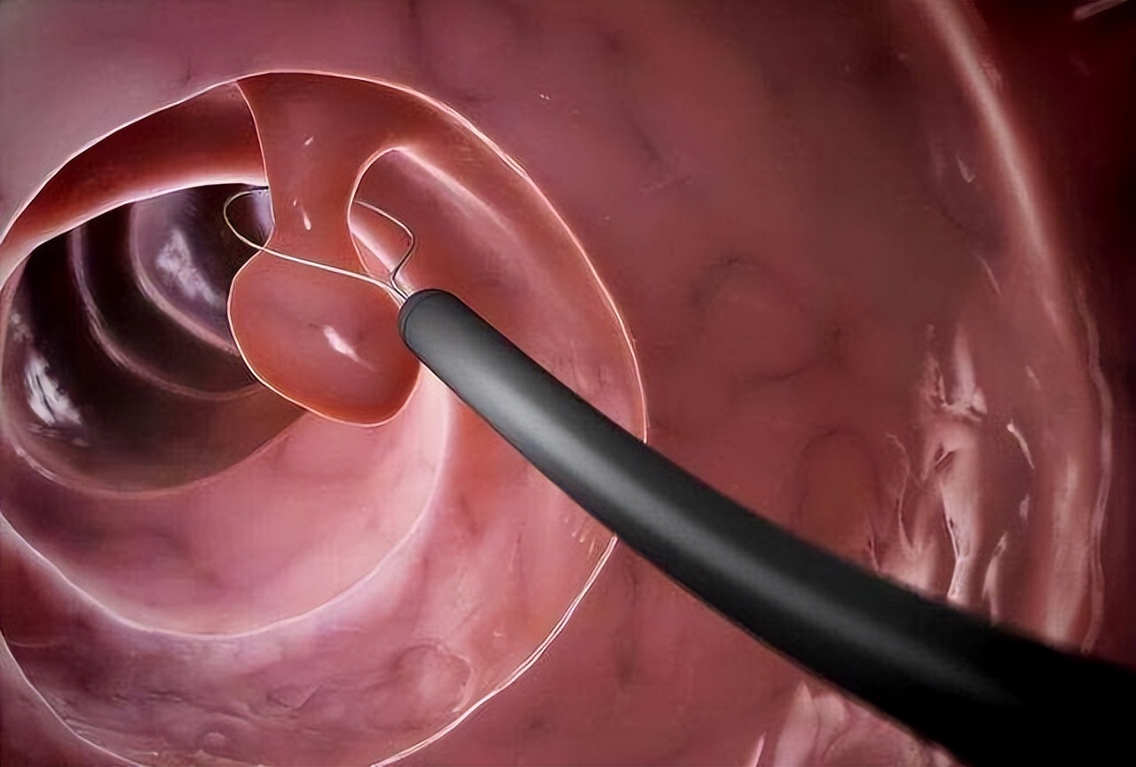 肠镜检查很痛吗大概多长时间完成,做一次肠镜有效期可持续多久