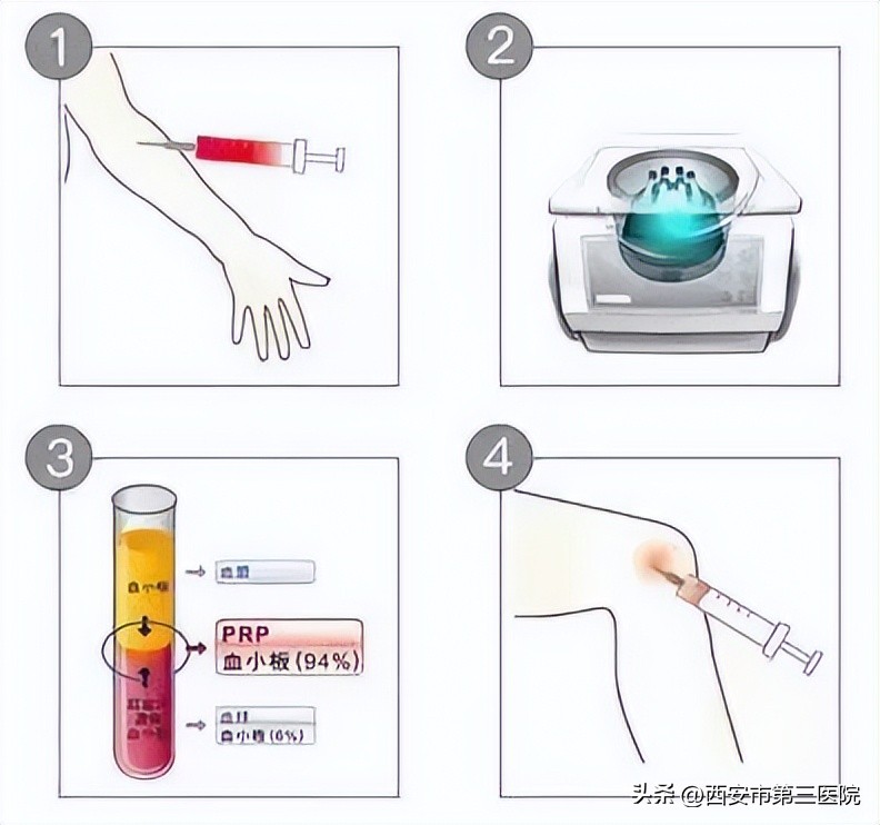 prp治疗膝关节弯曲角度效果,prp治疗膝关节有发热症状