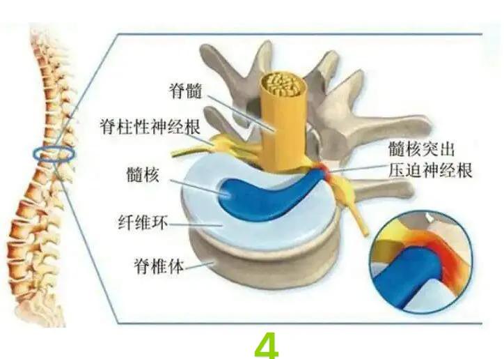 腰椎间盘突出手术要住院几天,治疗腰椎间盘突出的视频