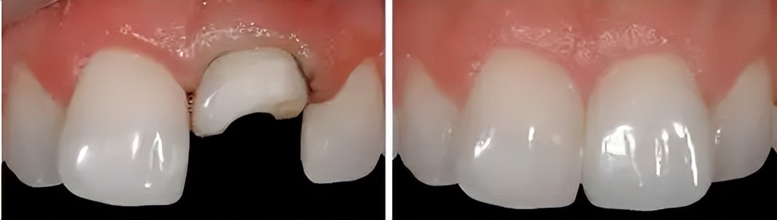牙齿断了一半怎么处理最好多少钱,牙齿断了一半怕冰怎么处理最好