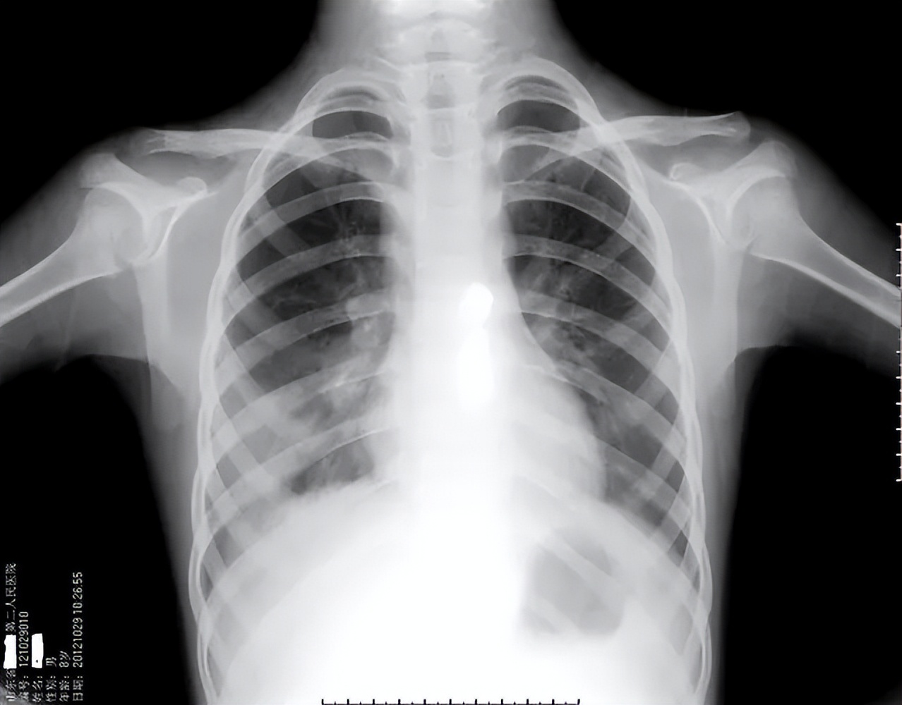 女子咳嗽咳出来肿瘤,女子咳血