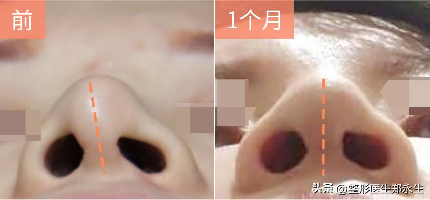 隆鼻后变朝天鼻修复成功案例,关于隆鼻失败