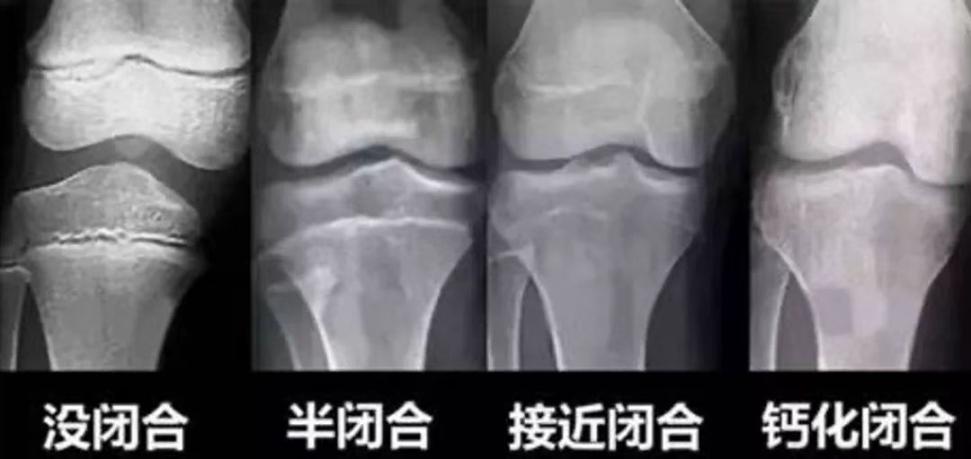 骨骺线不完全闭合啥意思,骨骺线闭合不可逆