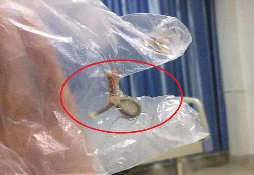 如果节育环过期了再取会怎样取,曼月乐节育环会长进肉里吗