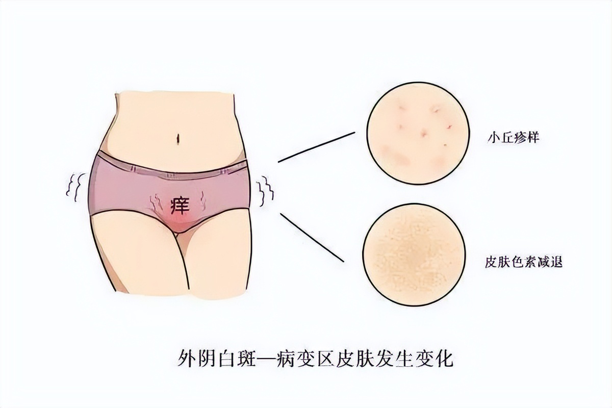 近二十年的外阴白斑要怎样治疗,无创治外阴白斑有效吗