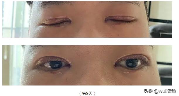 男生割双眼皮的意思,男生眼睛小割双眼皮会好看吗