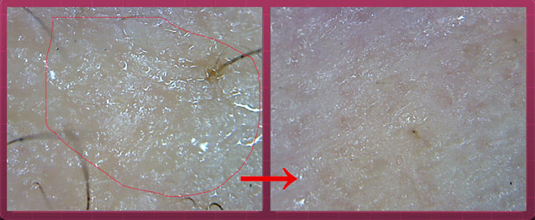 洗完澡身上痒还起皮是怎么回事,洗完澡皮肤干燥起皮浑身痒