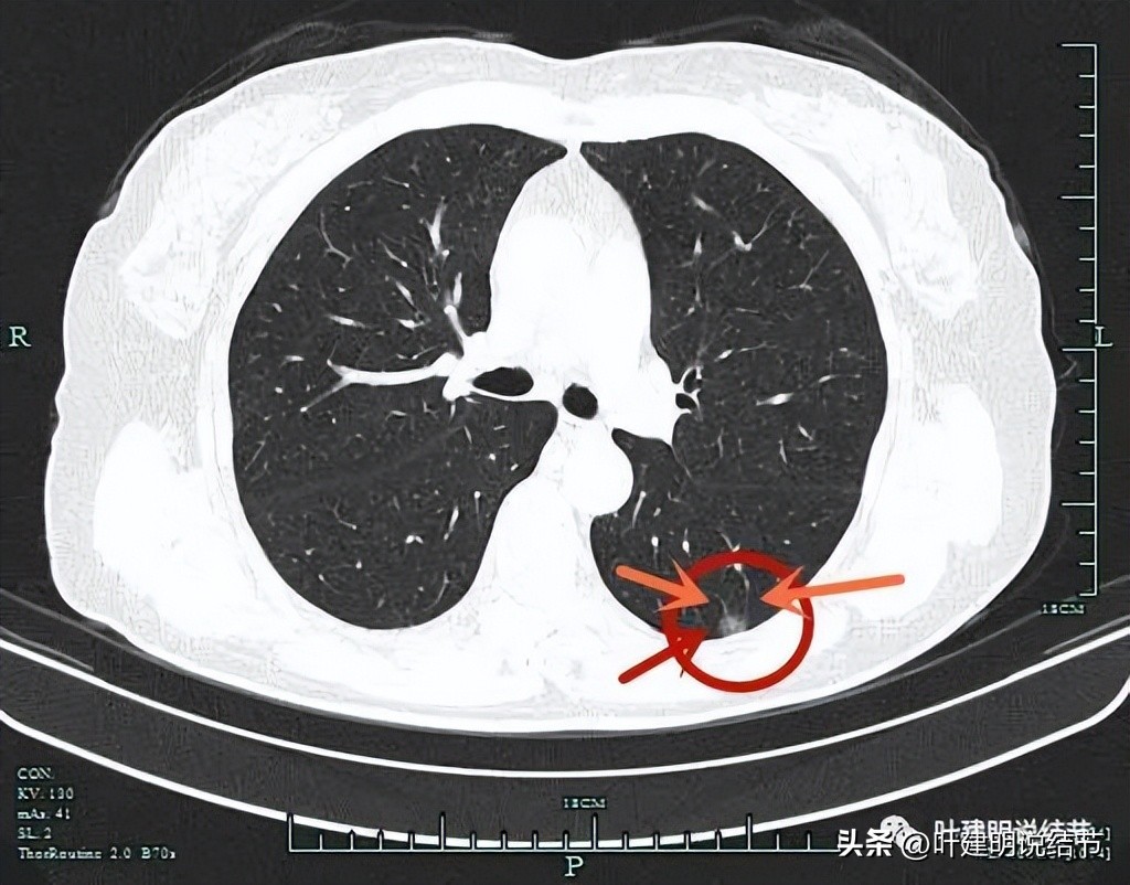成立肺癌诊疗一体化中心,构建肺癌精准诊疗生态圈