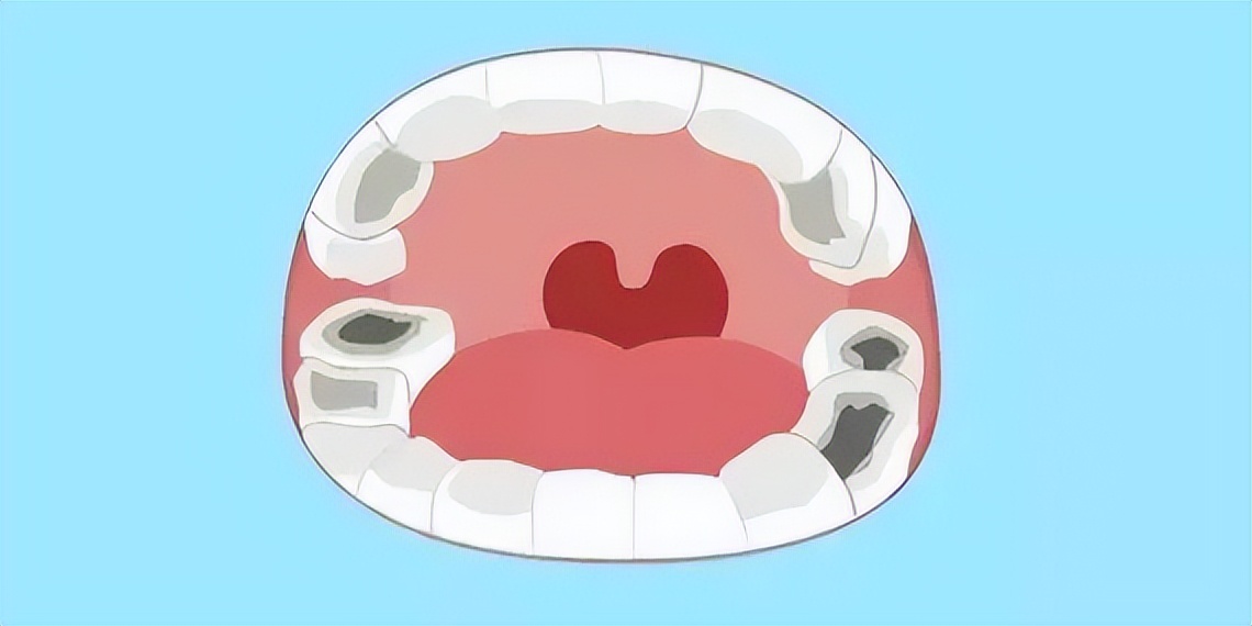 乳牙被蛀了可以补牙吗,乳牙被虫蛀掉了恒牙不出咋办