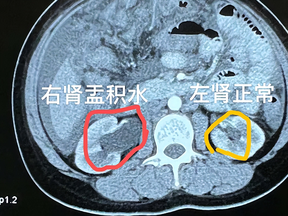 直肠癌转移的方式,直肠癌转移盆腔化疗方案