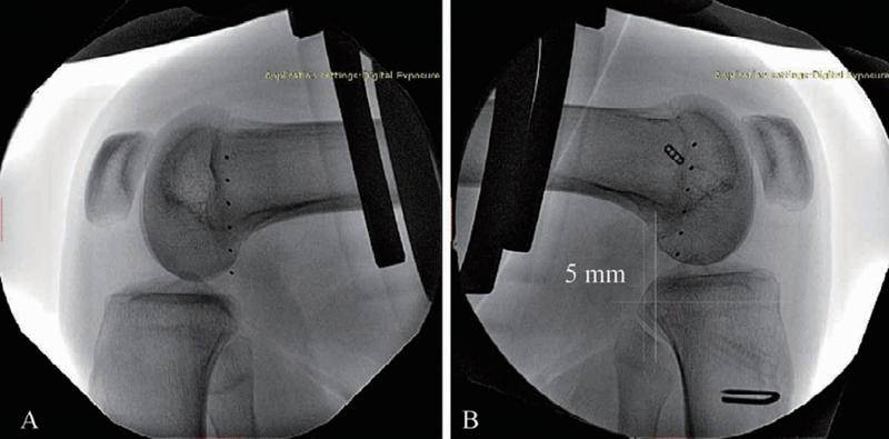 膝关节前交叉韧带损伤怎么治,十字交叉韧带损伤如何解决