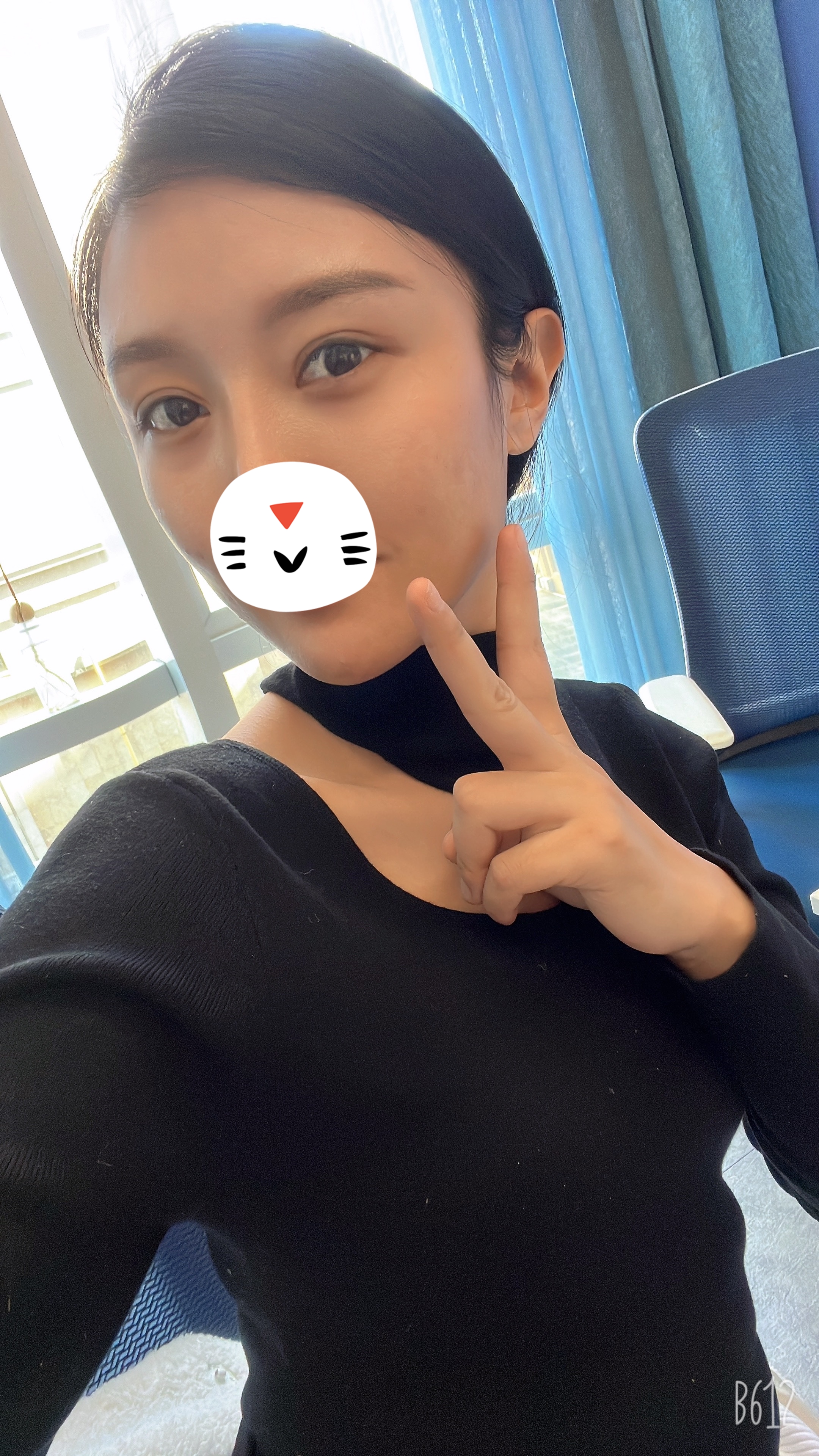 双眼皮修复新乡,姑娘眼部整形后双眼皮变三眼皮