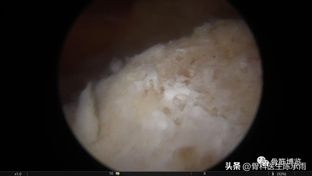 化脓性关节炎的穿刺引流治疗,关节炎镜下治疗