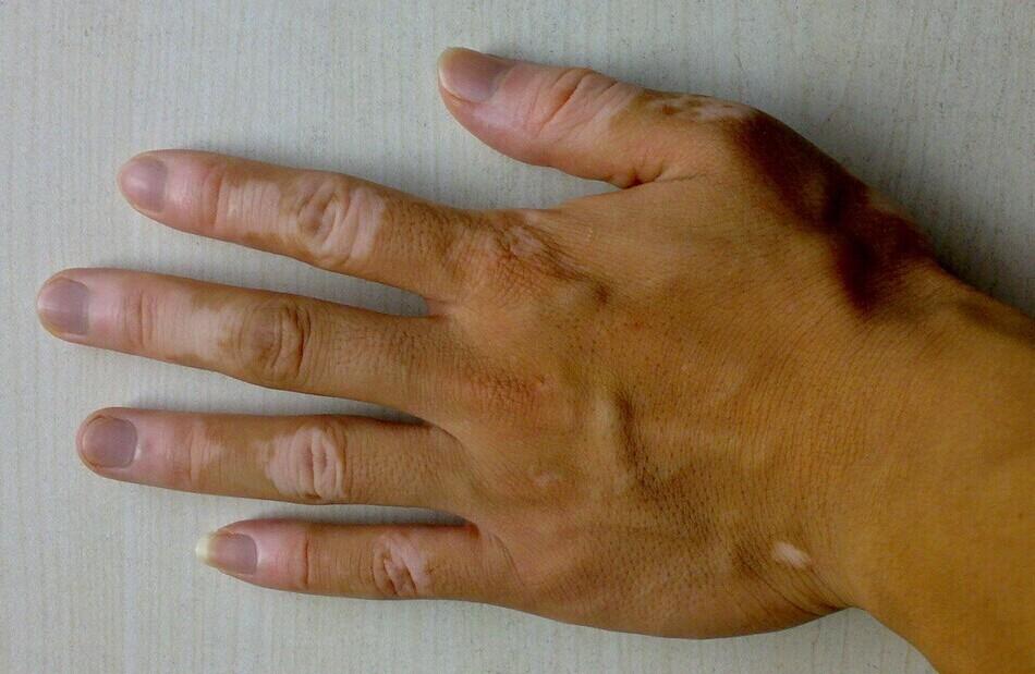 老年人突然长很多老年斑怎么回事,老年人有老年斑夏天用什么护肤品