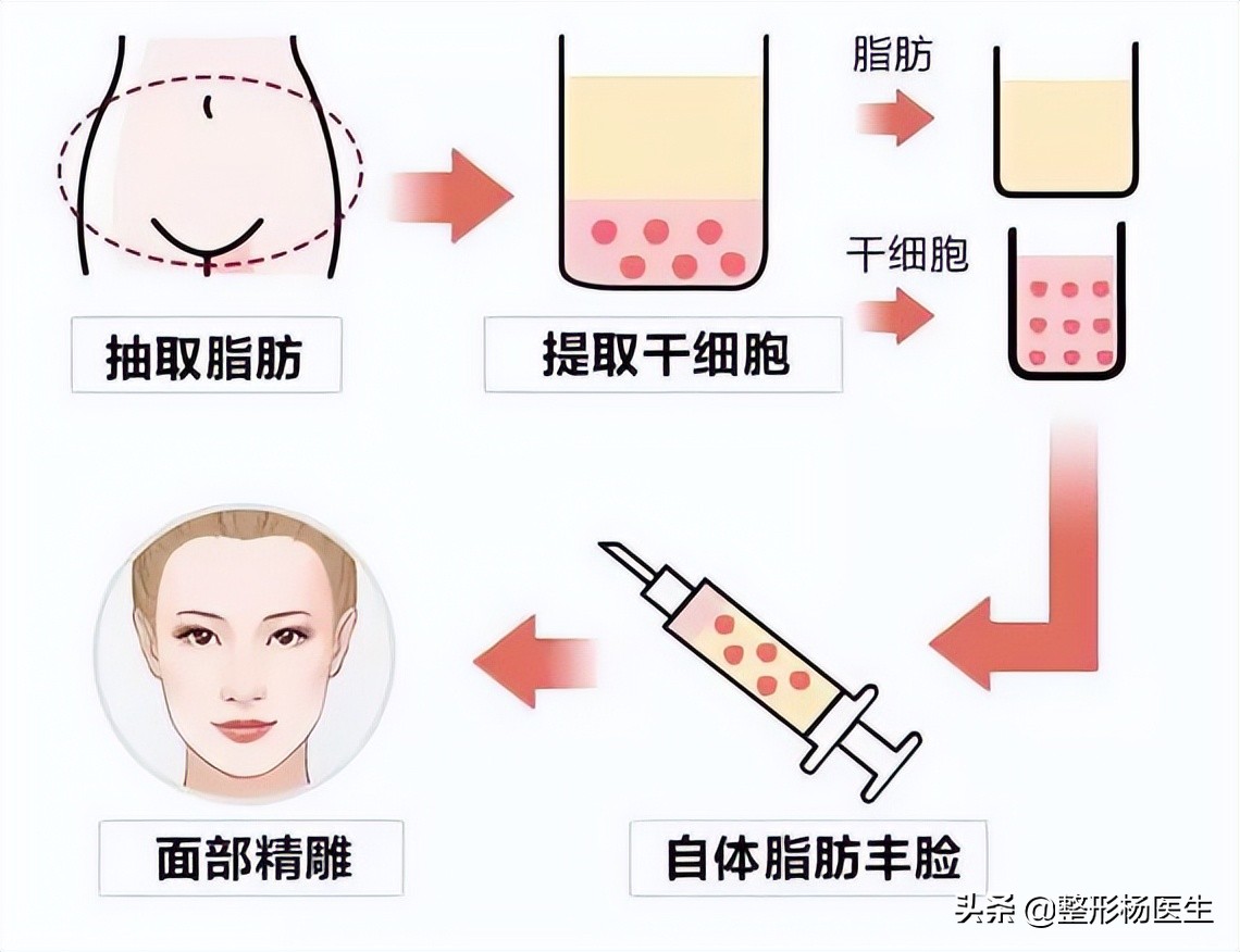注射隆鼻和假体隆鼻哪个好,隆鼻和综合隆鼻整形有什么区别