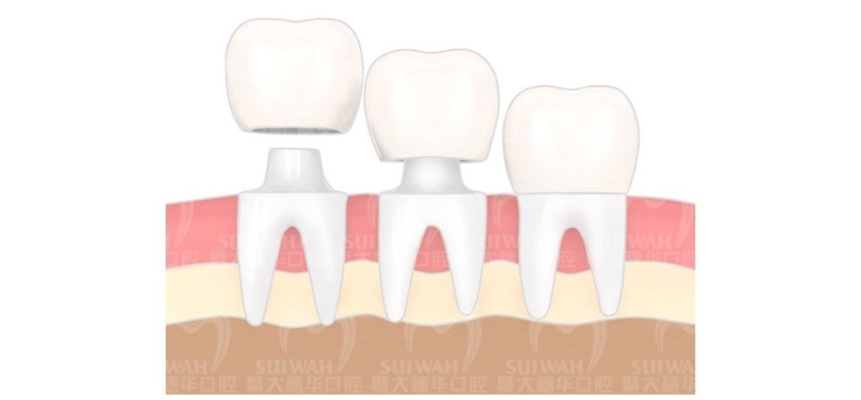 根管治疗后不戴牙套后坏掉了,根管治疗后不戴牙冠的后果