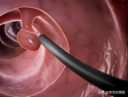 肠镜检查有多发性肠息肉,肠镜检查报告单怎么看肠息肉大小