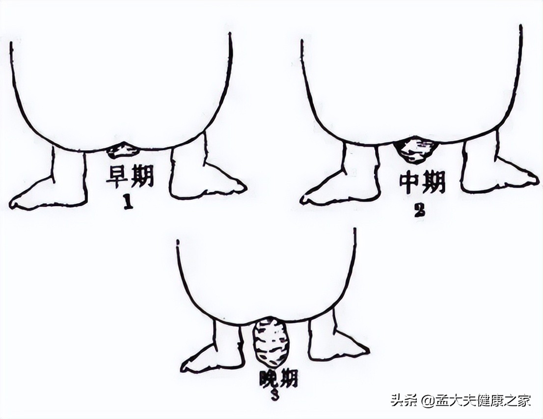 肛门掉出来肉球怎么治疗,肛门掉出紫色肉球怎么治疗