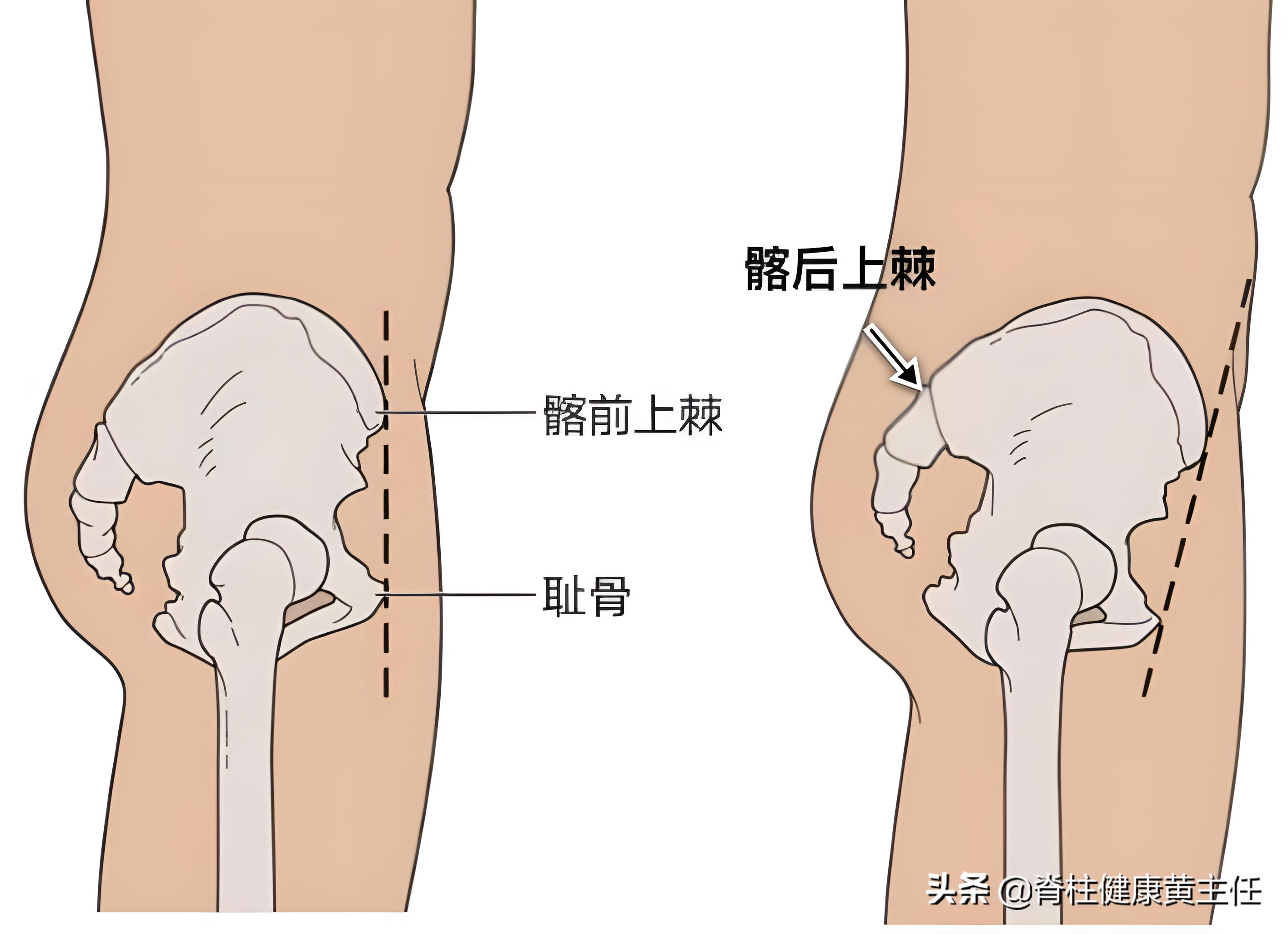小腹突出骨盆前倾怎么纠正,怀疑骨盆前倾需要去医院治疗吗