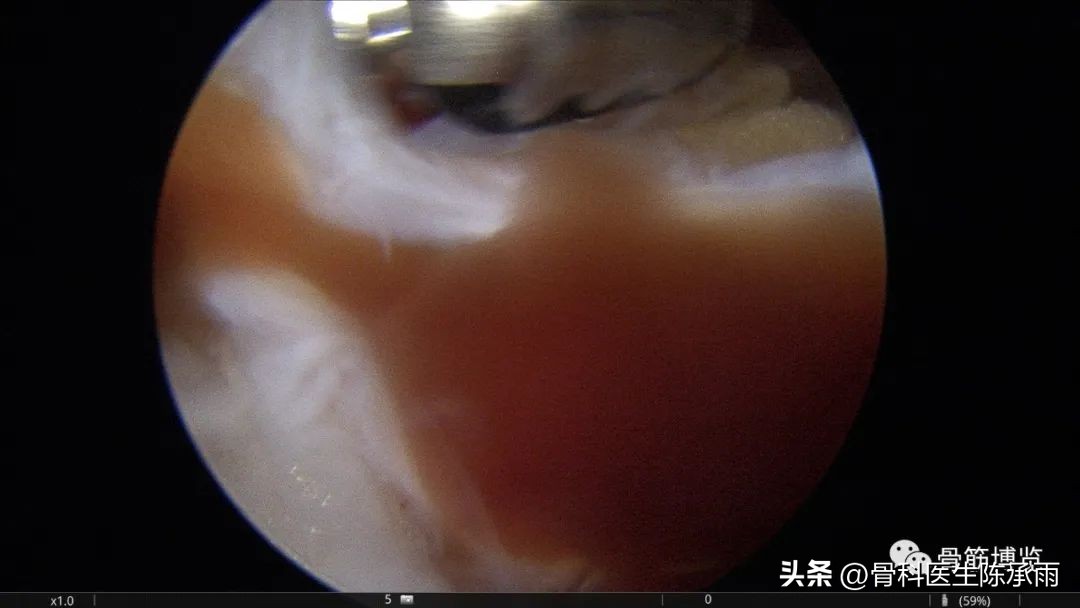 内侧半月板前角囊肿,关节镜下内侧半月板部分切除术