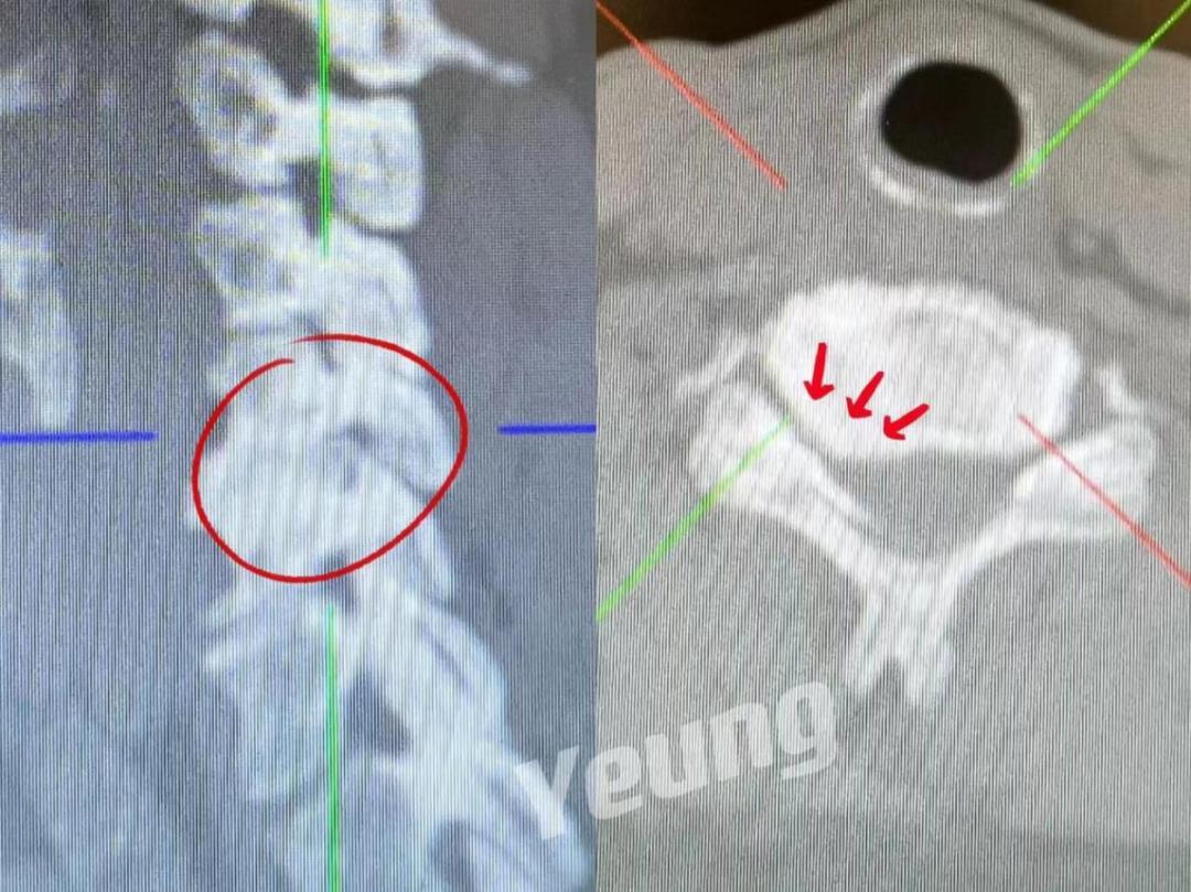 西安椎间孔镜手术治疗颈椎,西安红会医院微创