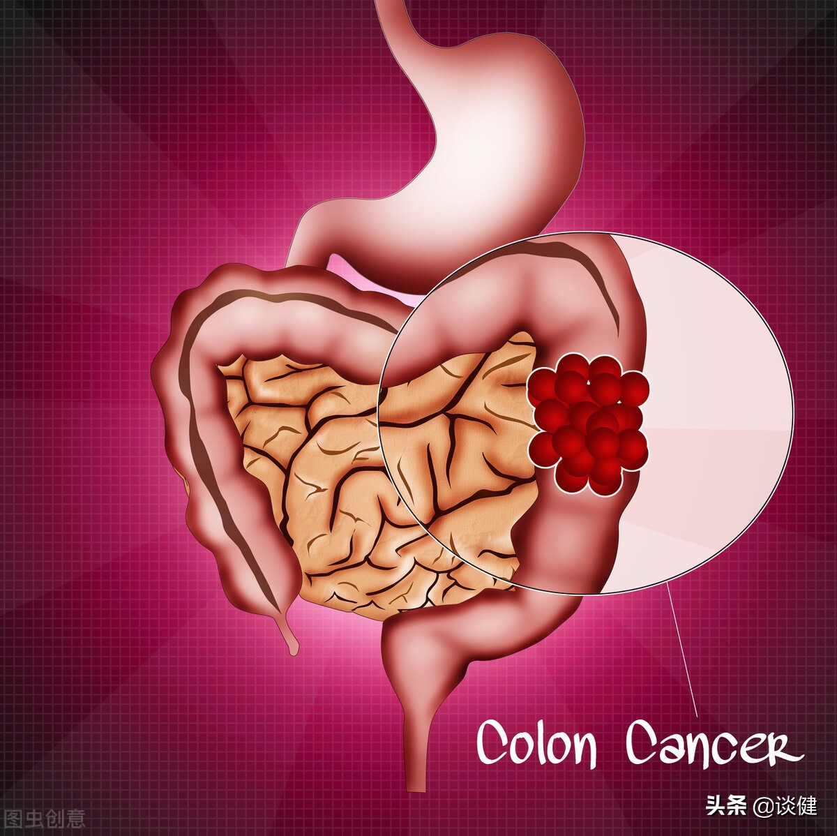 黑斑息肉切除后小的息肉会癌变吗,大肠息肉癌变严重吗