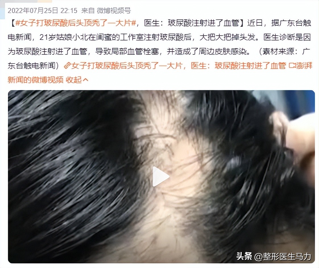 鼻基底玻尿酸栓塞后续治疗方法,鼻基底打玻尿酸栓塞后打溶解酶