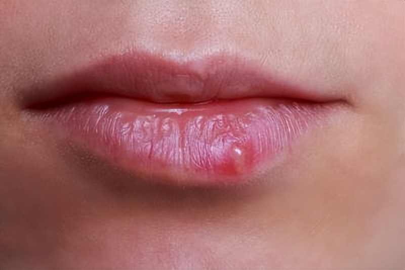 烂嘴角是怎么回事是上火吗,烂嘴角到底是什么病
