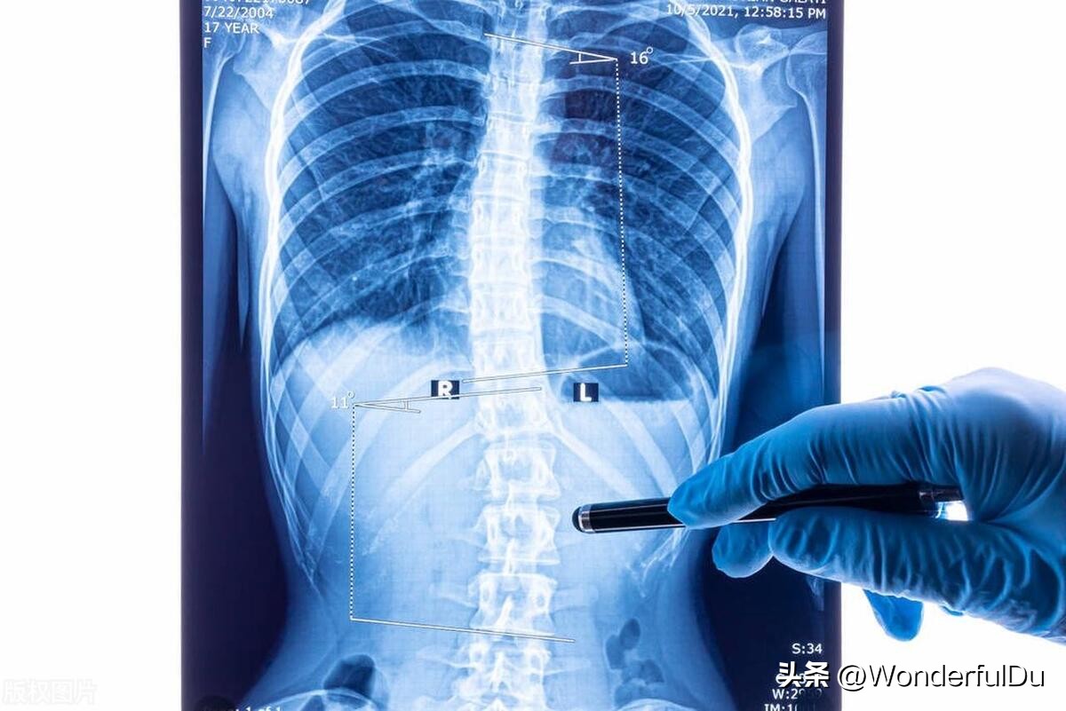 脊柱侧弯矫正改善,脊柱侧弯达到多少度需要矫正