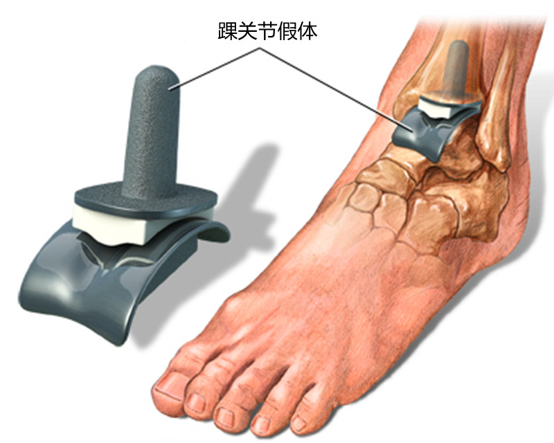 习惯性崴脚可以彻底治好吗,习惯性崴脚后怎么办