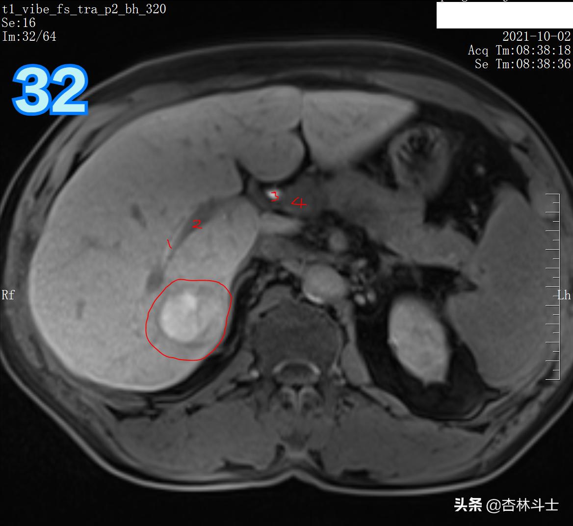 肝癌8公分肿瘤能活多久,肝癌细胞最大长多大