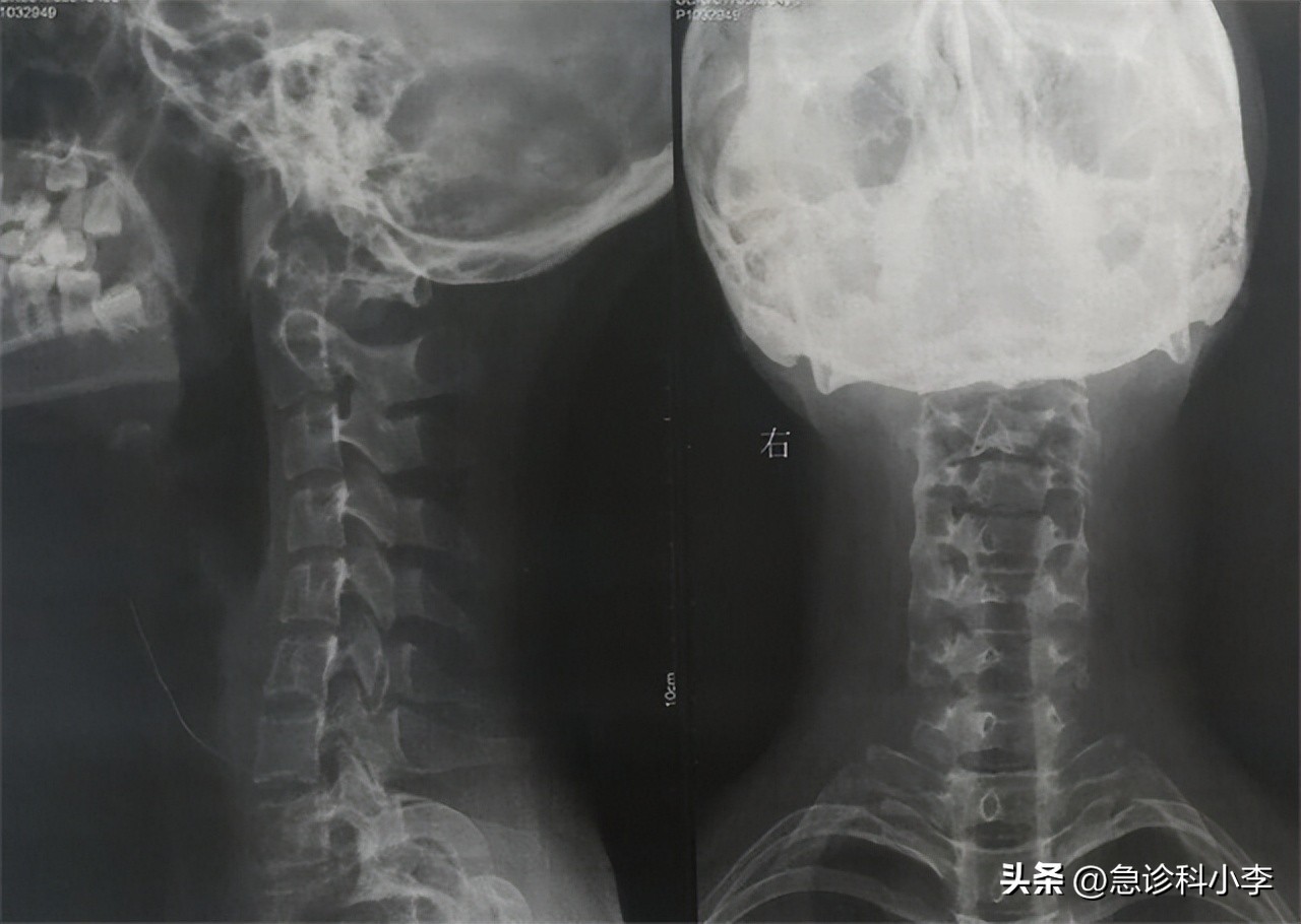 甲状腺实性结节4a癌变几率有多大,长了甲状腺结节癌变的几率有多大