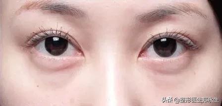 眼袋手术失败再次修复完交费吗,修复失败眼袋手术效果好吗