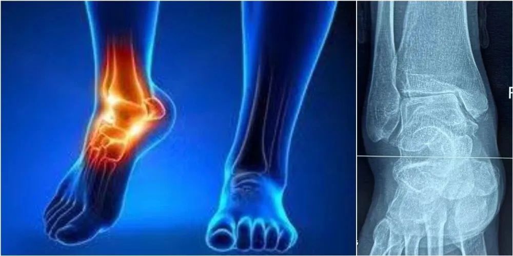 太马来了，跑友们要注意足踝部的运动损伤！