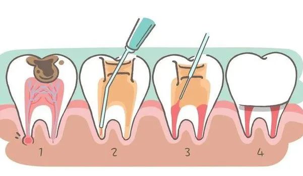 上火牙龈长脓包自己扎破挤出脓液,口腔牙龈疙瘩是上火长的吗