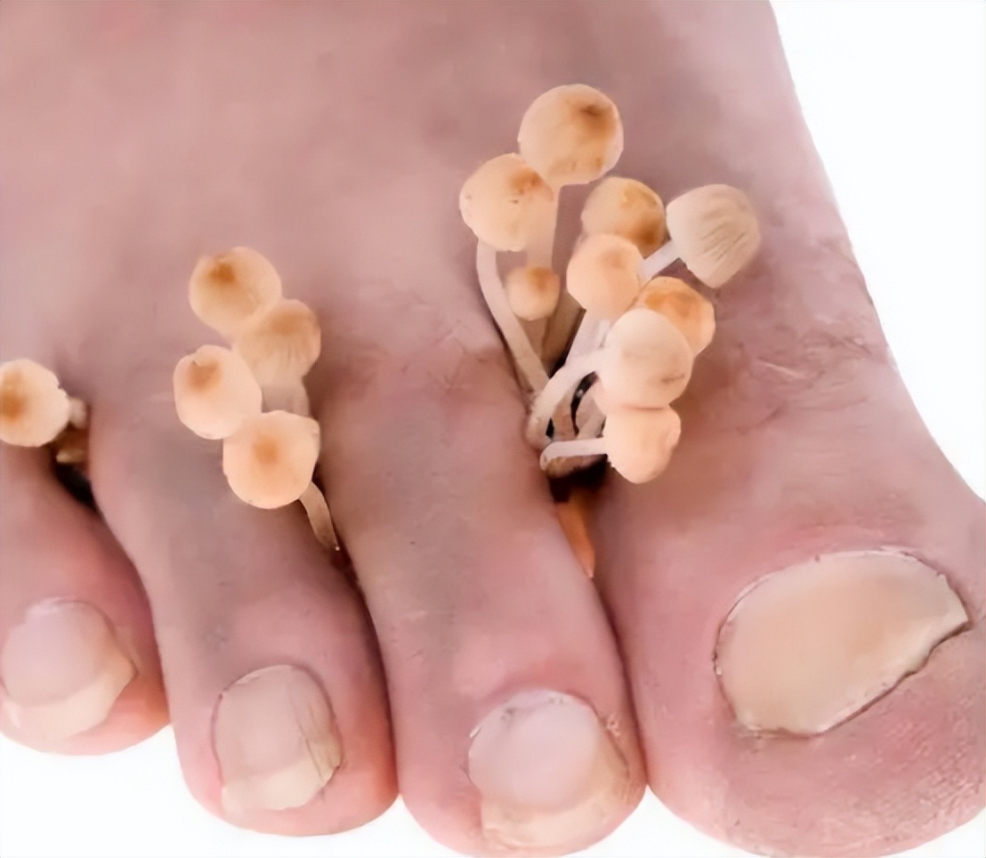 梅毒脚的典型表现!多数人却以为是得了脚气,白白耽误了病情