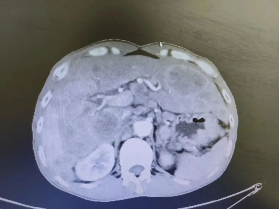 胃癌晚期化疗的全过程视频,化疗过程视频完整版胃癌