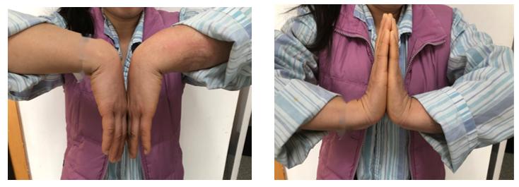 治疗骨折新技术,微创手术治疗骨折的方法