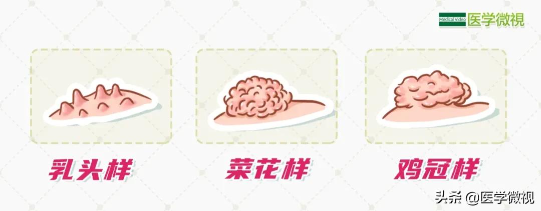 一种形如“菜花”，三分之二会传染给伴侣的病