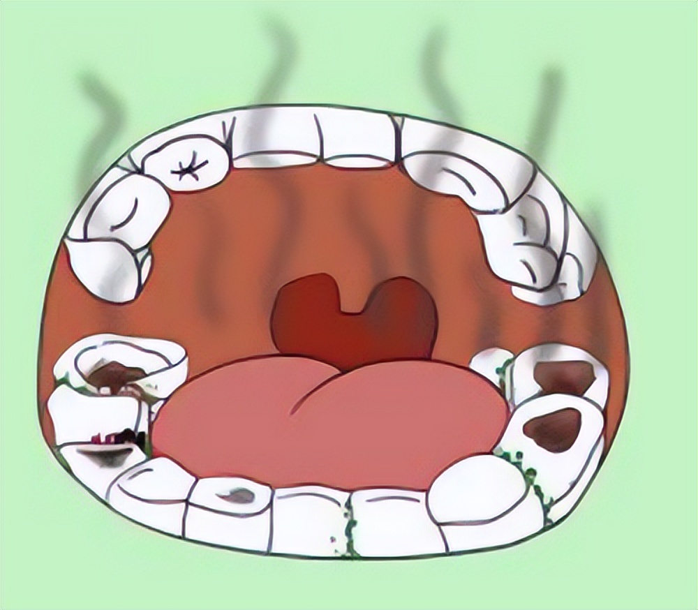 接吻会传染牙病吗,口腔湿疣患者接吻会传染吗