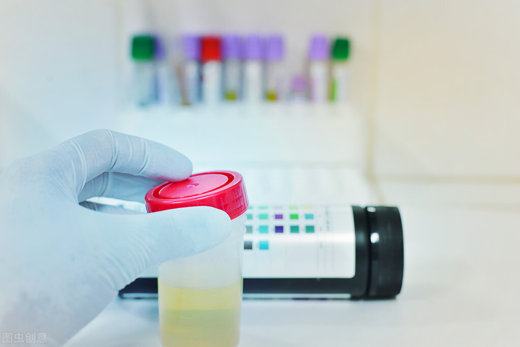 尿常规化验单指标不正常,尿常规化验单怎么看细菌