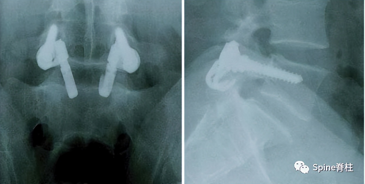 峡部裂和隐性峡部裂有区别吗,单纯峡部裂可以做峡部修复吗