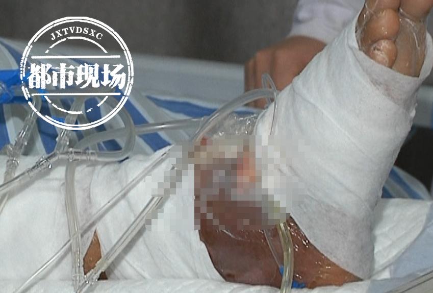 骑车摔伤伤口溃烂下陷用什么药好,男子骑车脚被划伤竟大面积溃烂