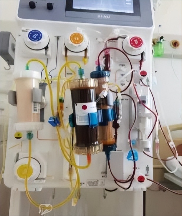 渭南市中心医院血透室成功开展首例“人工肝”技术