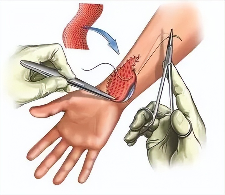 割了的包皮去哪了,28岁了包皮有必要割吗