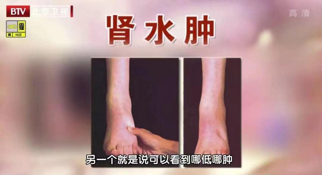 为什么肾病会持续发展,得了肾病记得远离3个误区