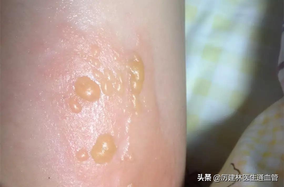 红霉素眼膏和红霉素软膏区别在哪,红霉素软膏和红霉素眼膏有啥区别