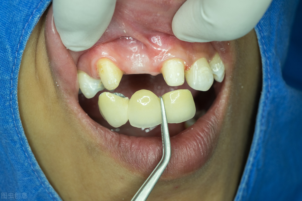 牙齿缺了一小块怎么办需要做牙冠,牙齿缺了一个角碰冷水会痛怎么办