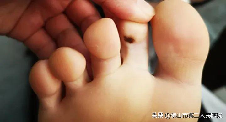 年轻歌手得黑色素瘤去世,歌手黑痣和黑色素瘤的区别