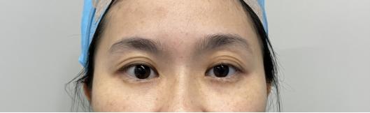 整形双眼皮失败案例,广州宝妈产后修复